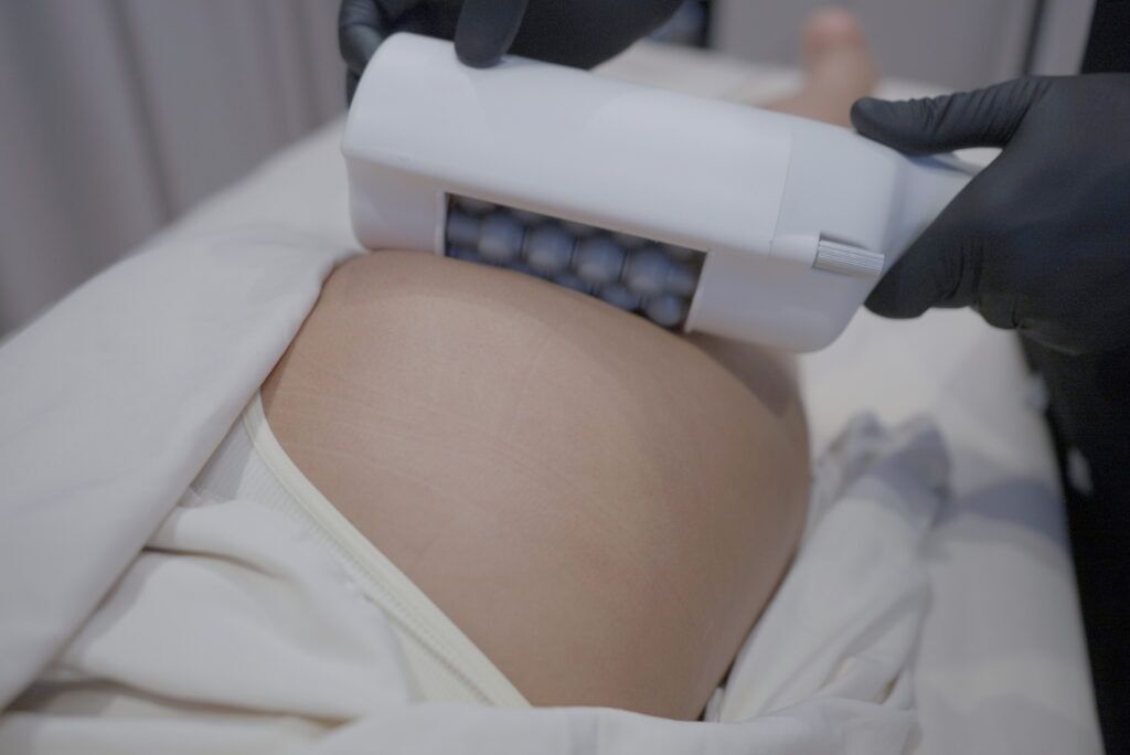 Close-up of Emsculpt NEO applicator being placed on a client's buttocks for body contouring at Modern Woman Med Spa Santa Rosa