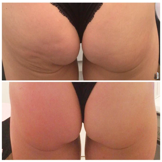 T-Shape 2 cellulite reduction before and after buttocks treatment at Modern Woman Med Spa Santa Rosa