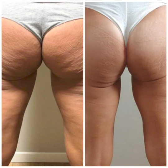 T-Shape 2 before and after cellulite smoothing on thighs at Modern Woman Med Spa Santa Rosa