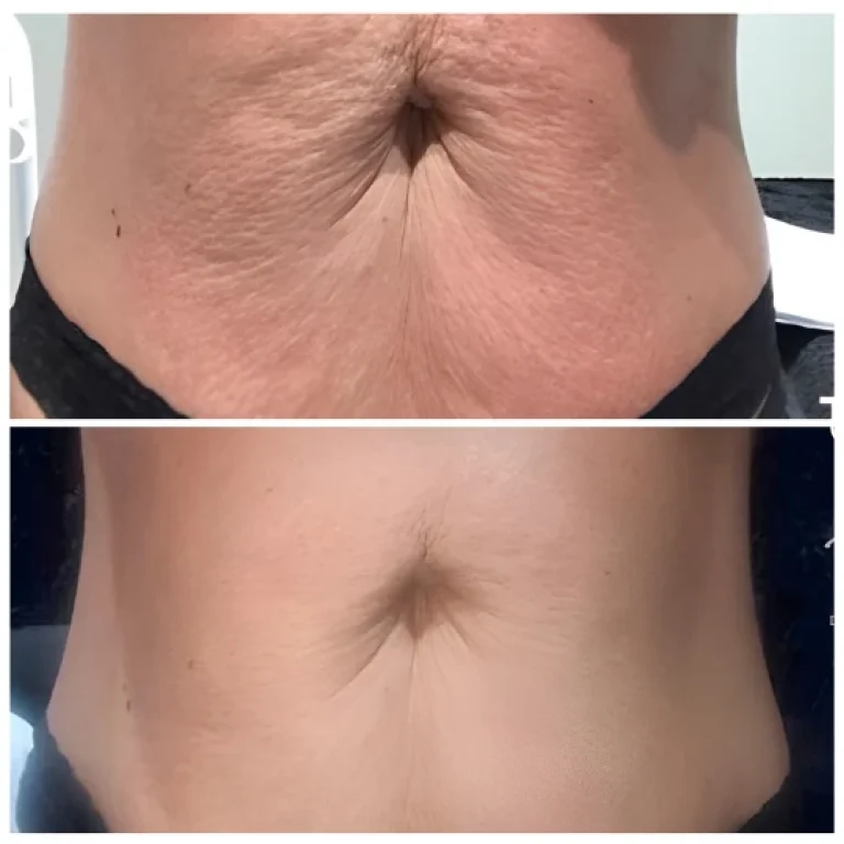 T-Shape 2 body contouring before and after abdomen skin tightening results at Modern Woman Med Spa Santa Rosa